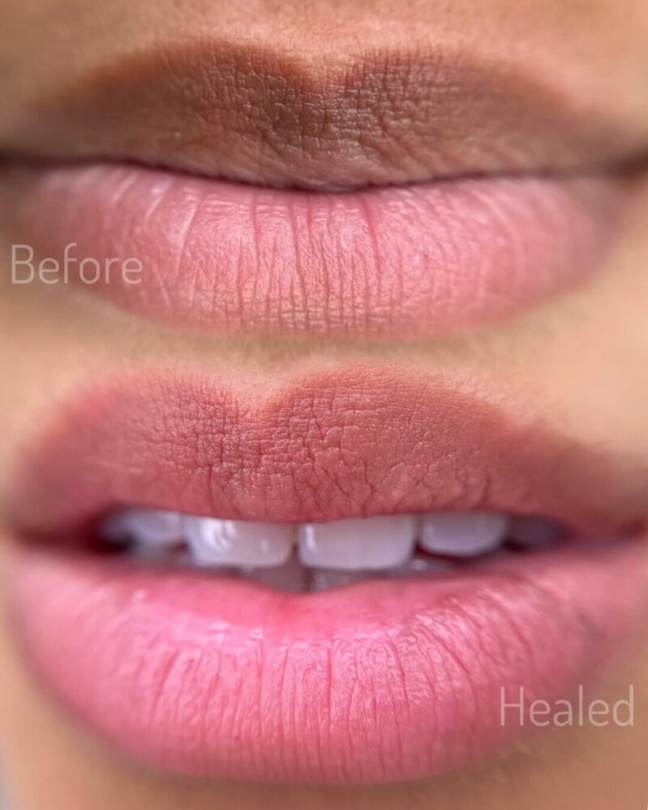 Full before-and-healed lip correction result